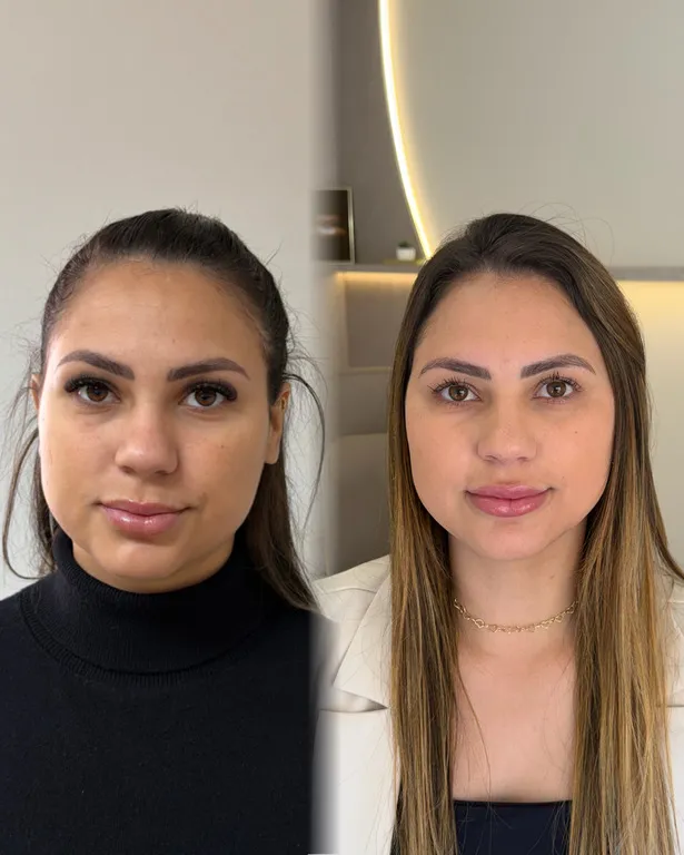 Bichectomia antes e depois em Ponta Grossa — Caso 3