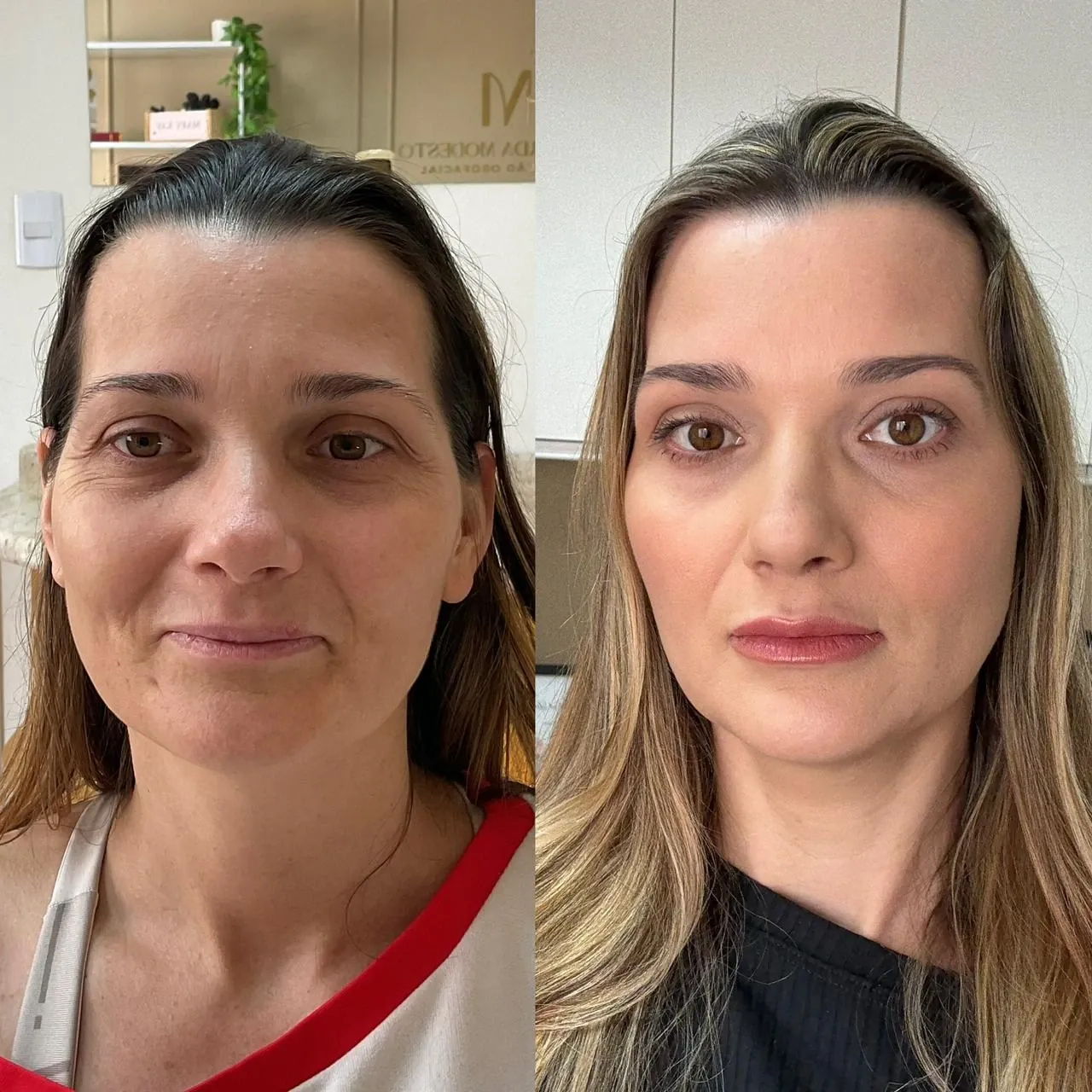 Bioestimuladores — resultado 2