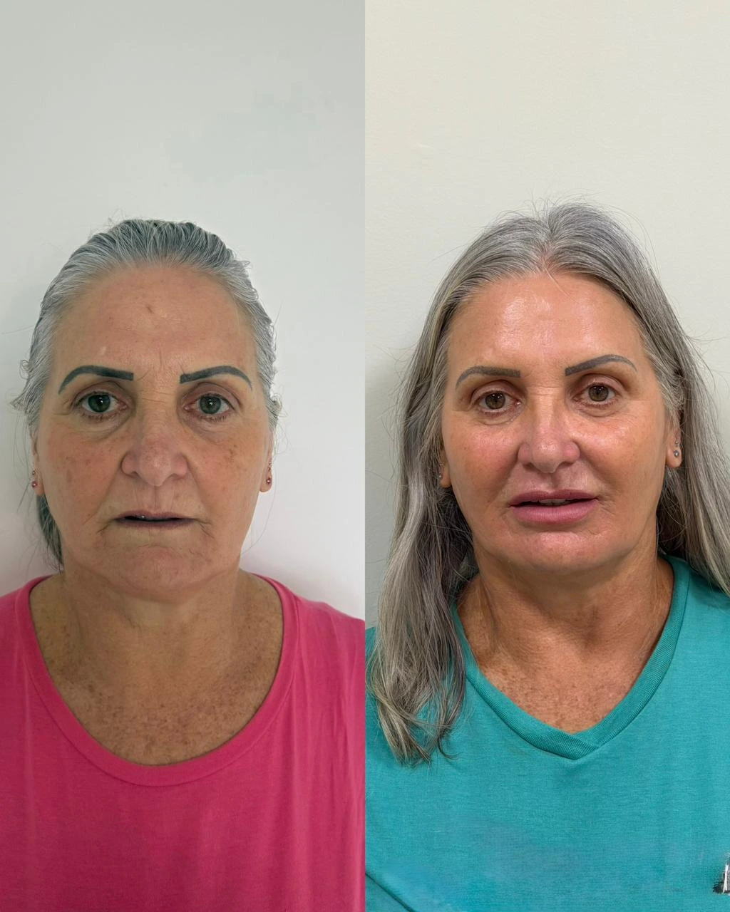 Bioestimuladores — resultado 3
