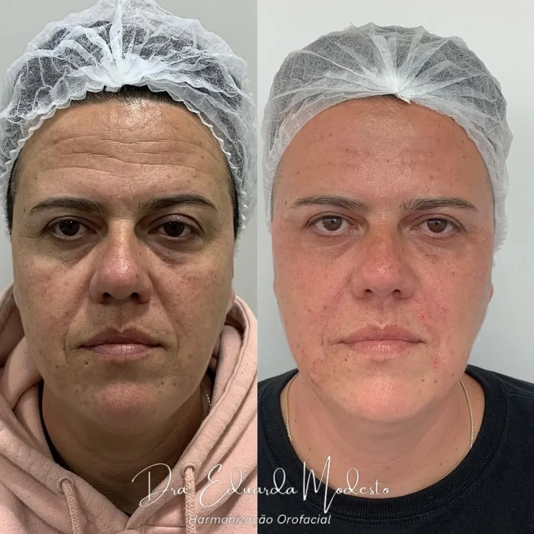 Botox — resultado 1