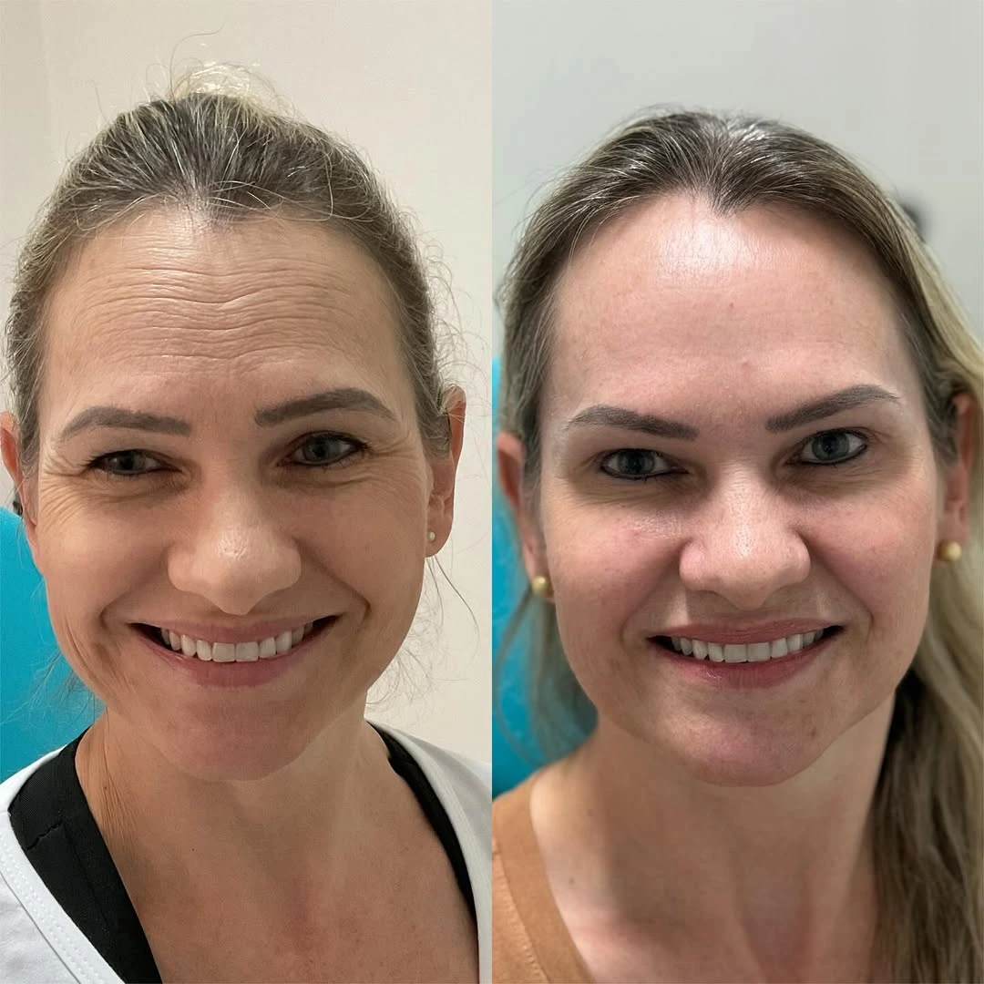 Botox — resultado 2