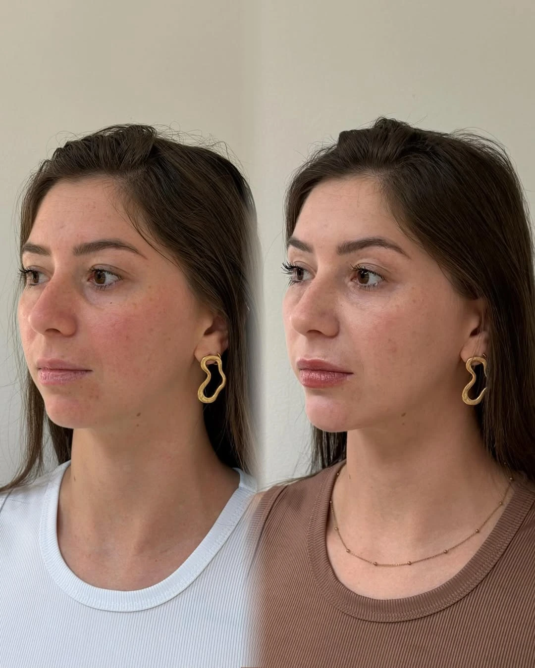 Preenchimento Labial — resultado 1