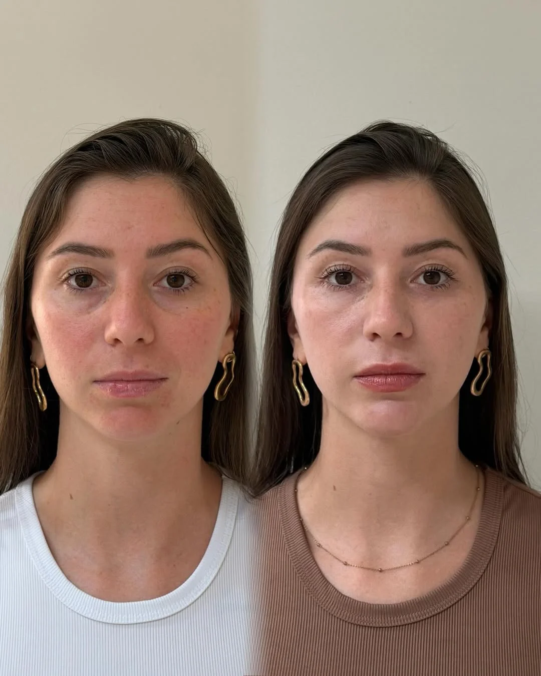 Preenchimento Labial — resultado 2