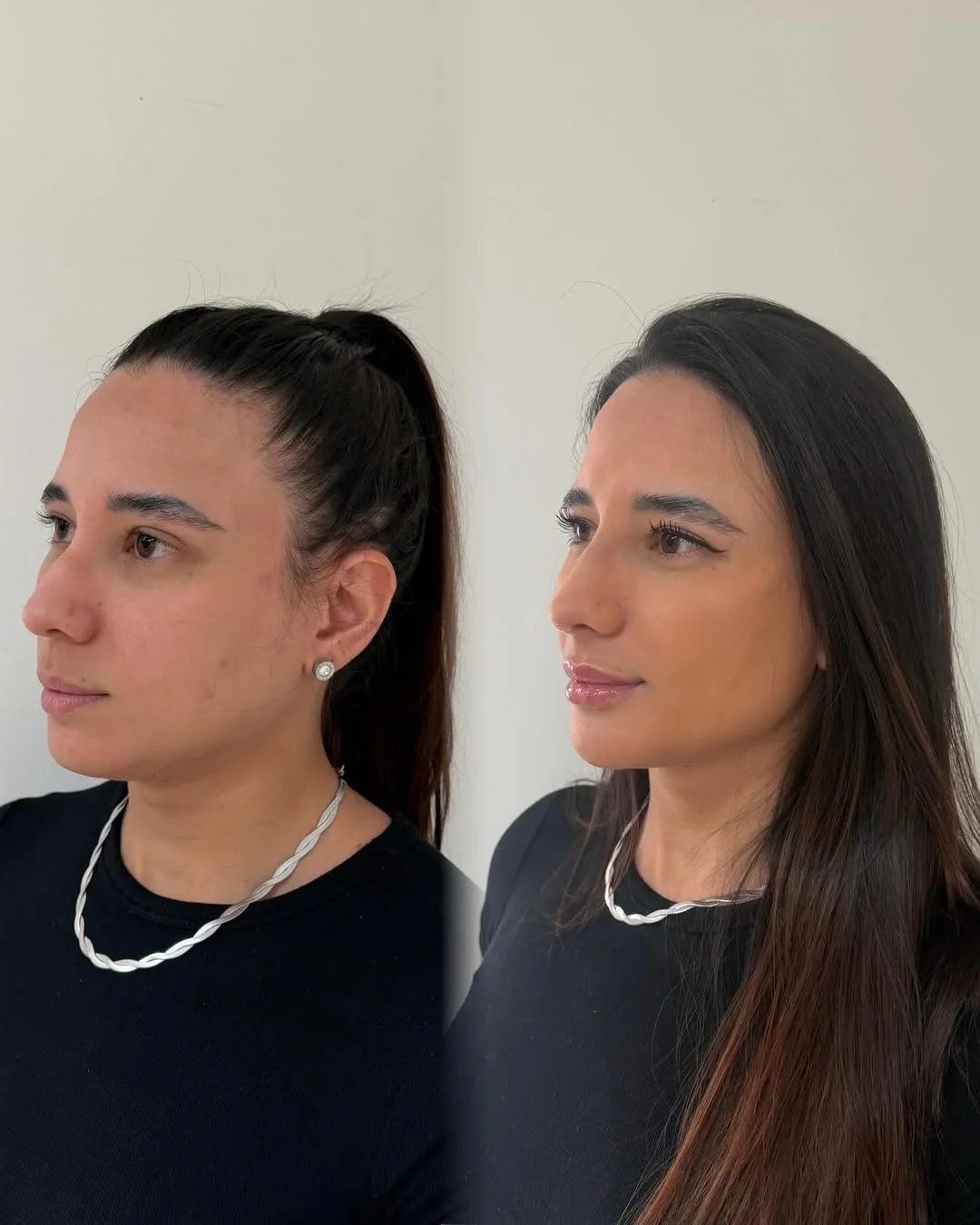 Preenchimento Labial — resultado 3